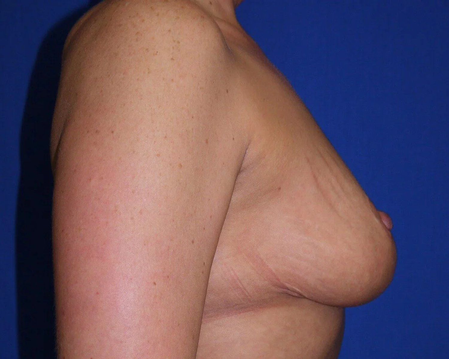 Breast Reduction, Oblique Right view, after