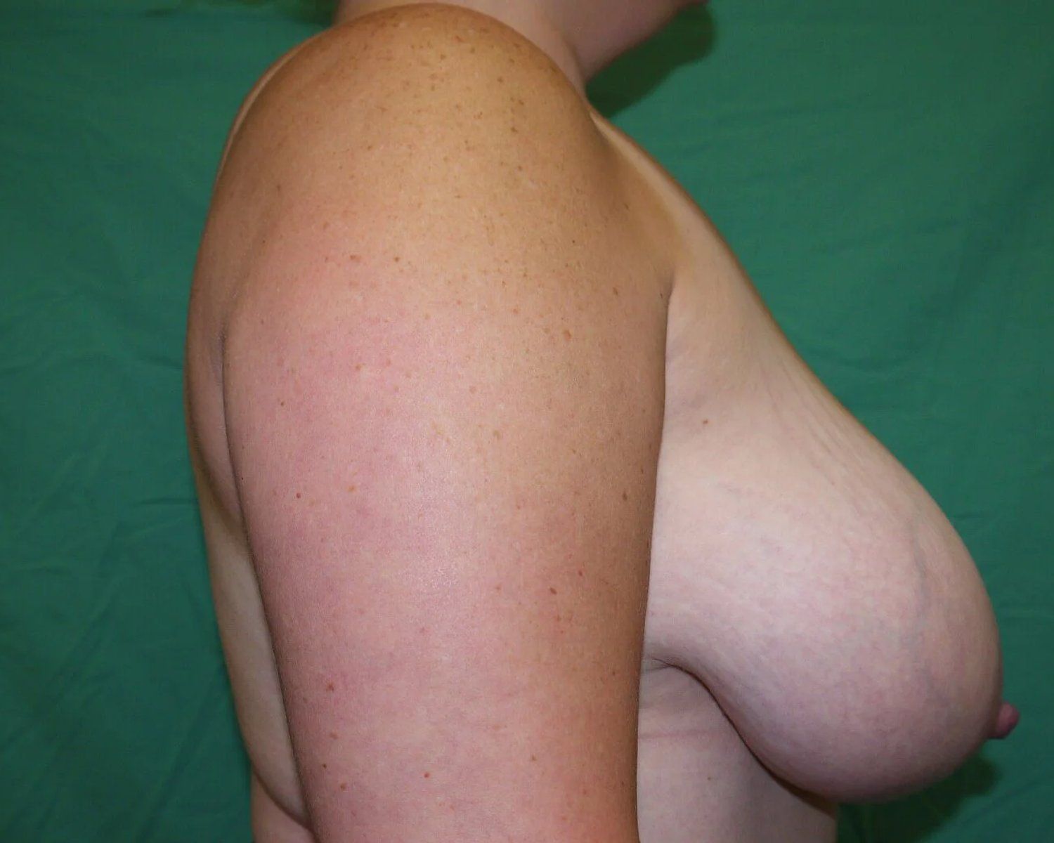 Breast Reduction, Oblique Right view, before