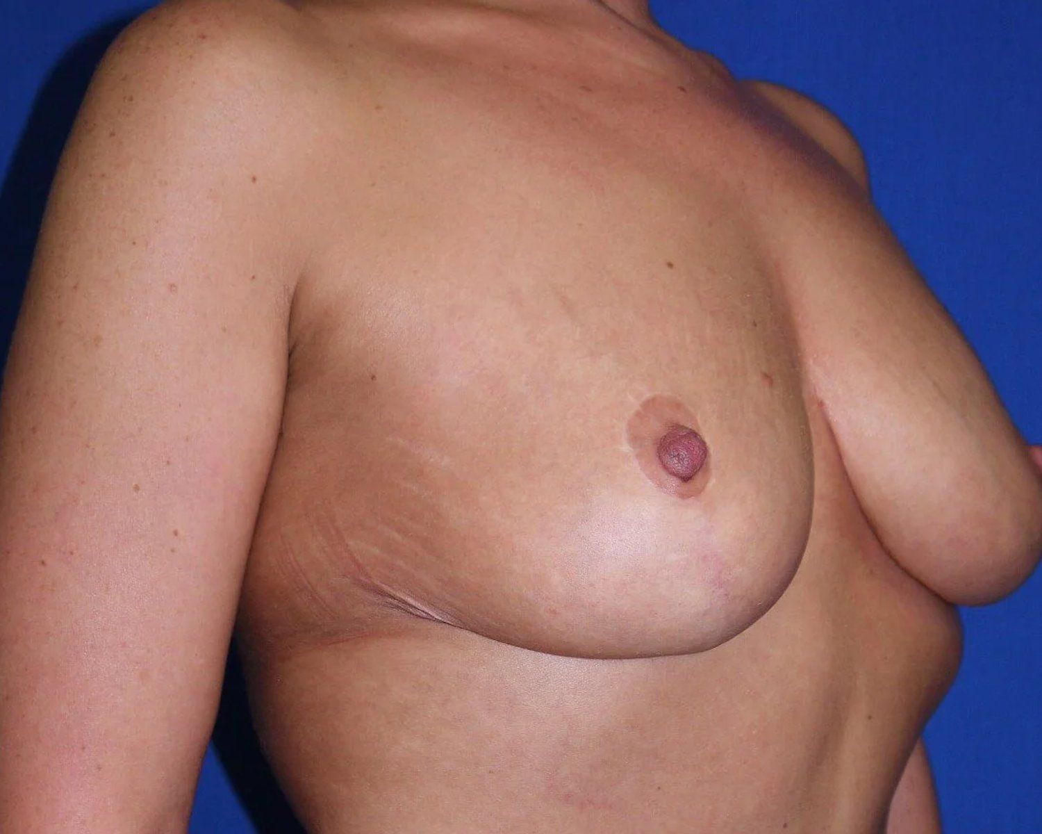 Breast Reduction after