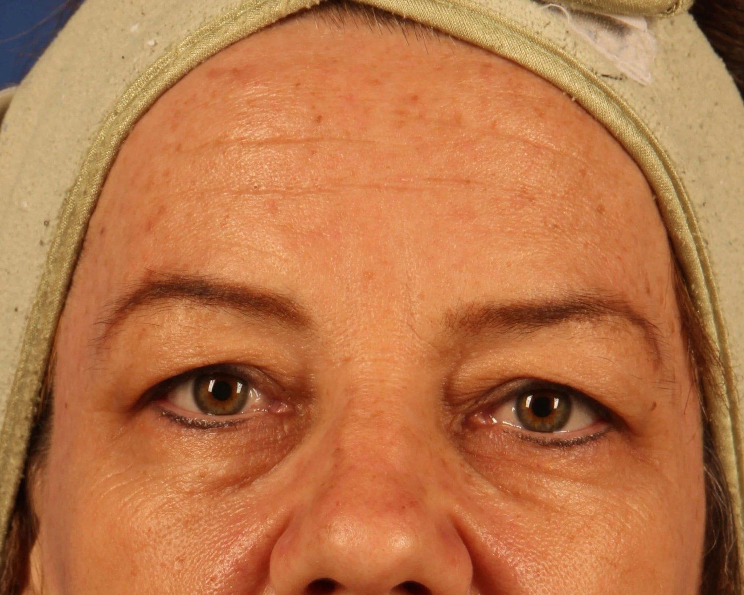 Eyelid Surgery before
