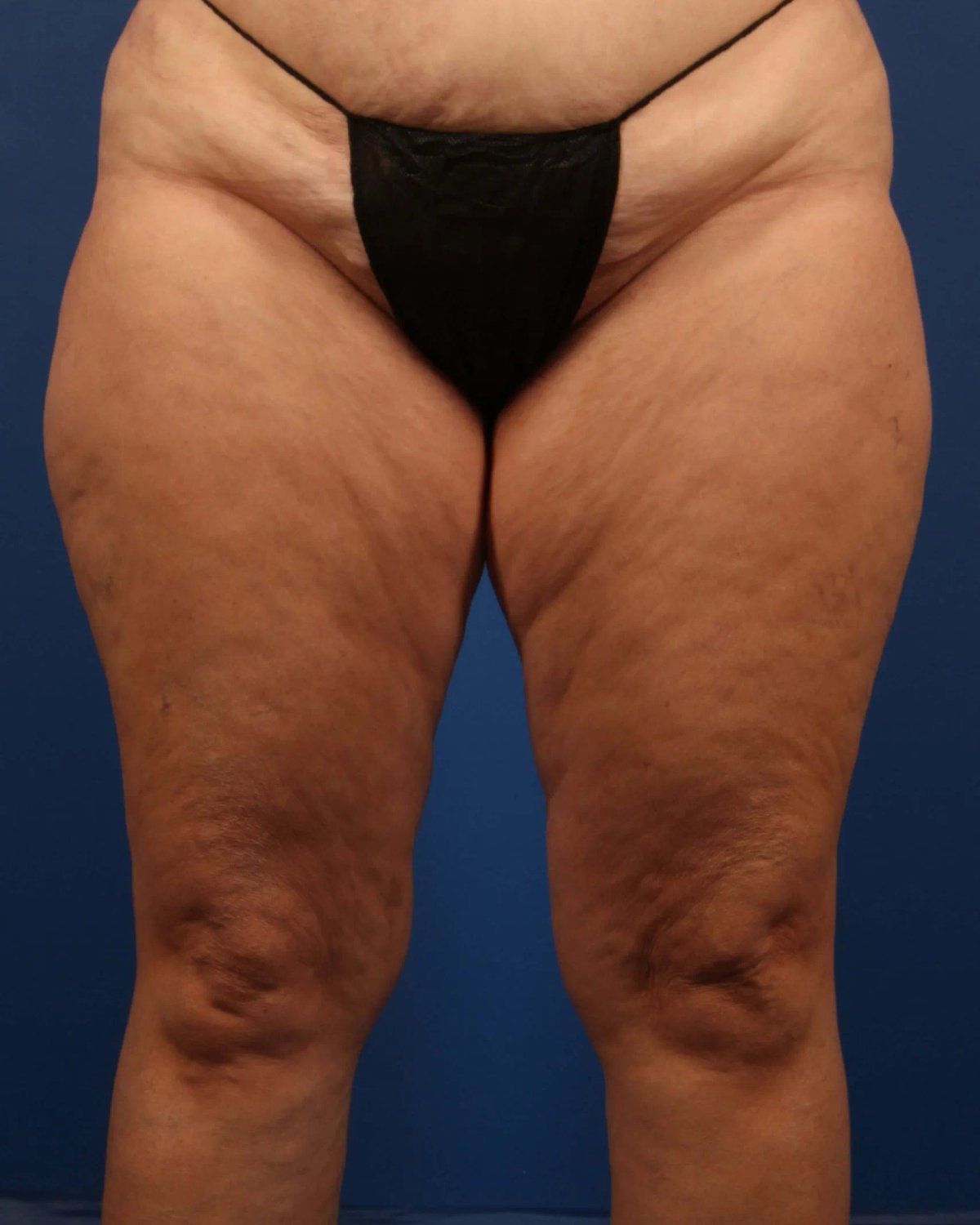 Thigh Lift (Medial) before