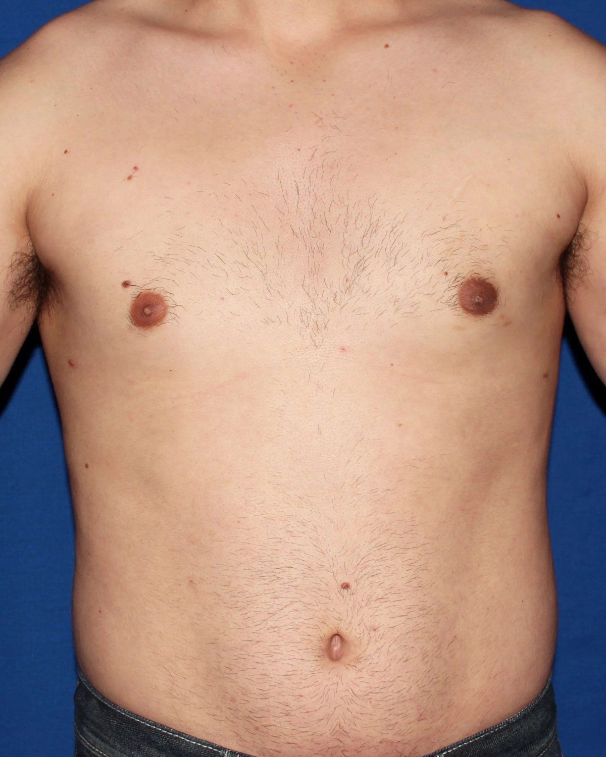 One-Stitch Gynecomastia after