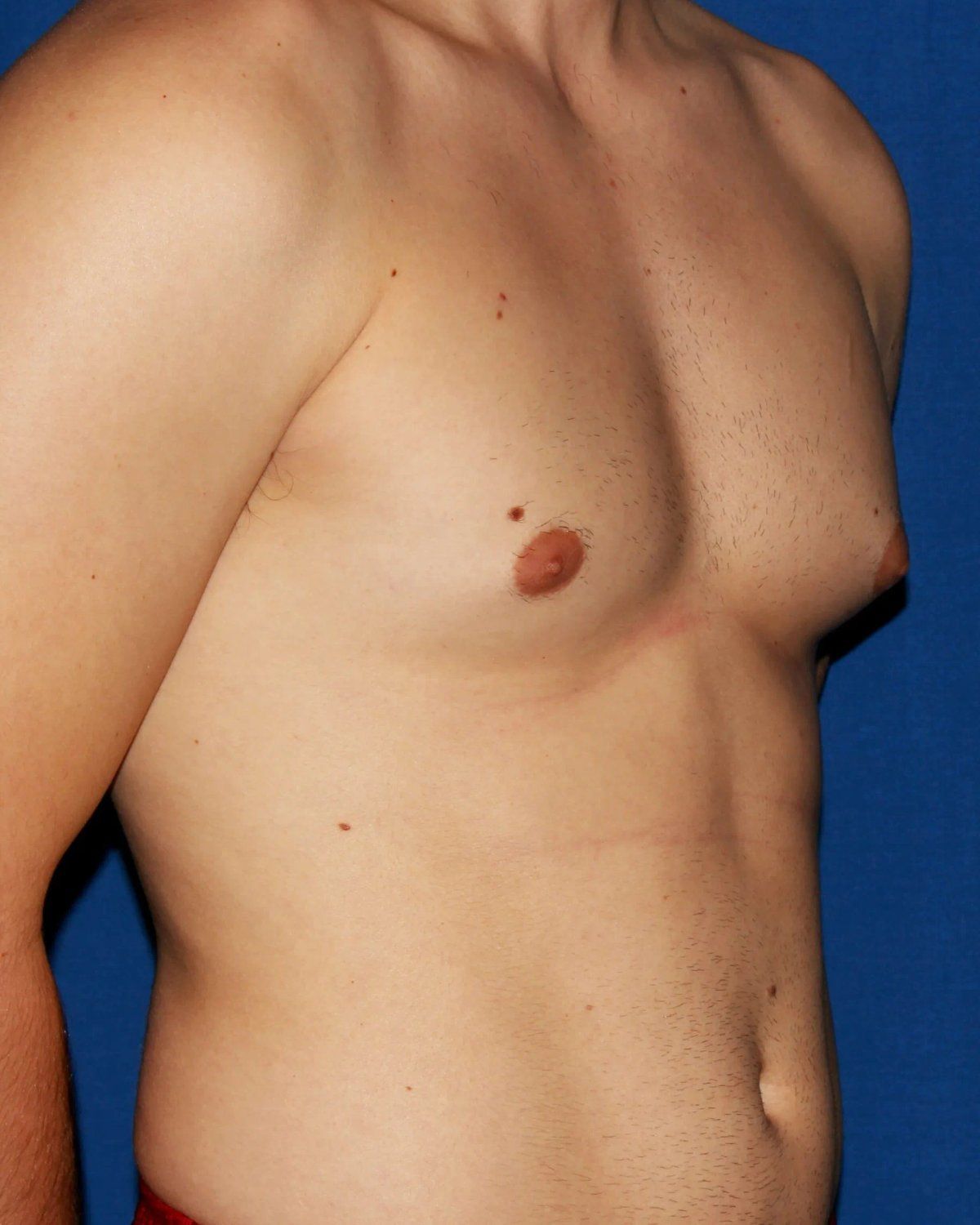 One-Stitch Gynecomastia — Oblique Right view, before