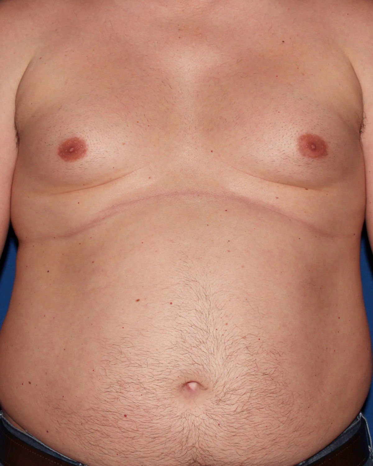 One-Stitch Gynecomastia before