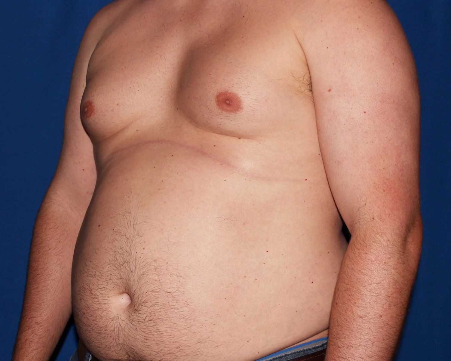 One-Stitch Gynecomastia — Oblique Right view, before