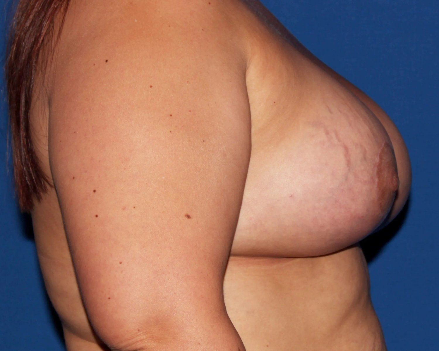 Breast Augmentation with Implants — Right Profile view, after