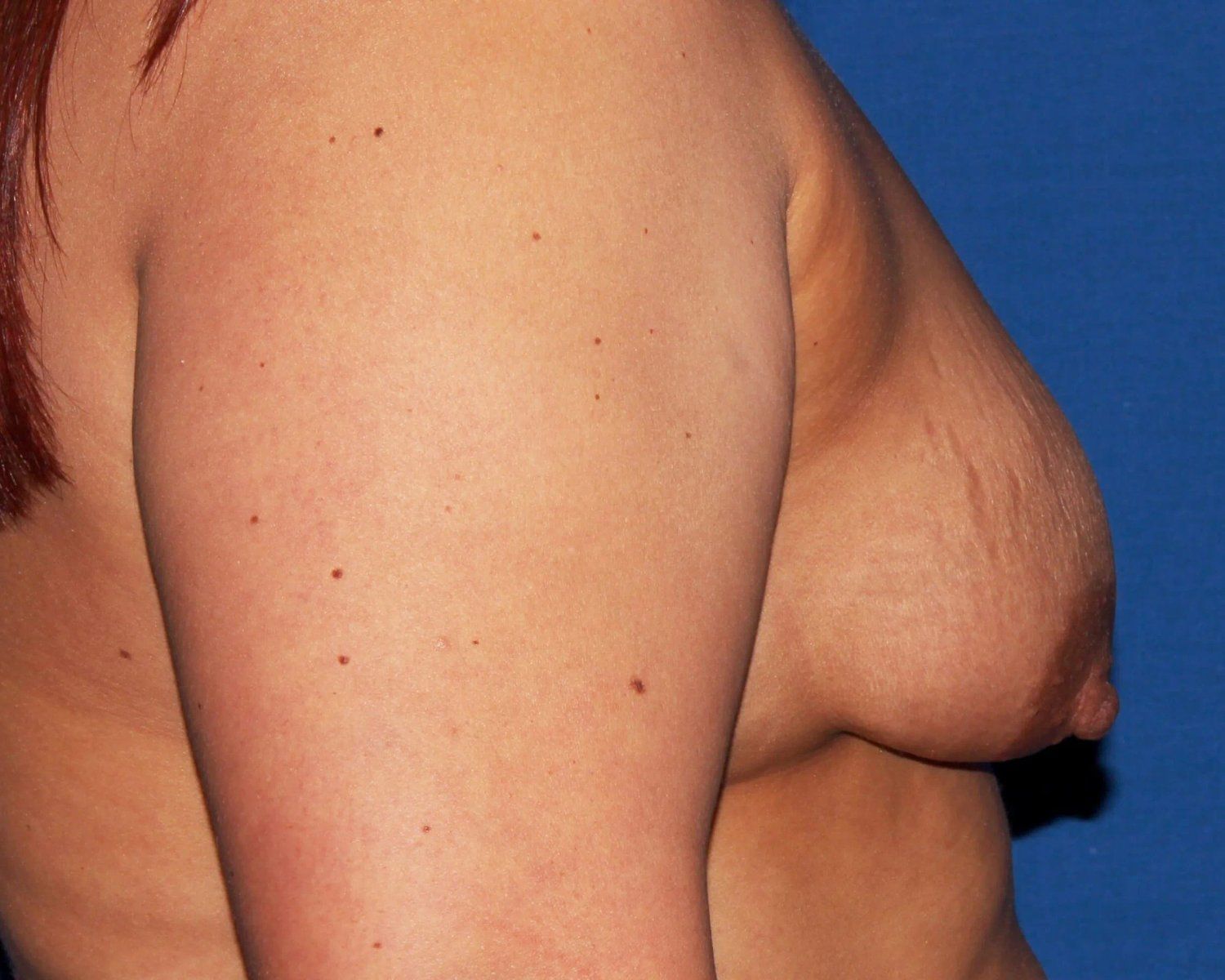 Breast Augmentation with Implants — Right Profile view, before