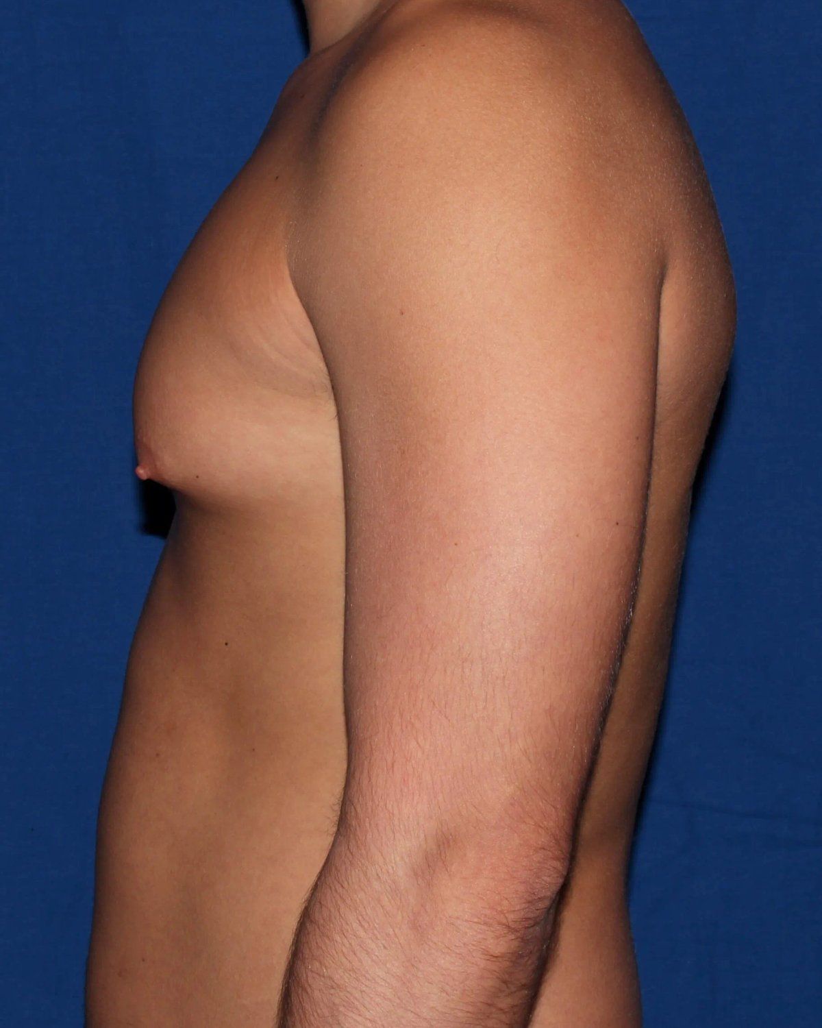 One-Stitch Gynecomastia — Oblique Left view, before