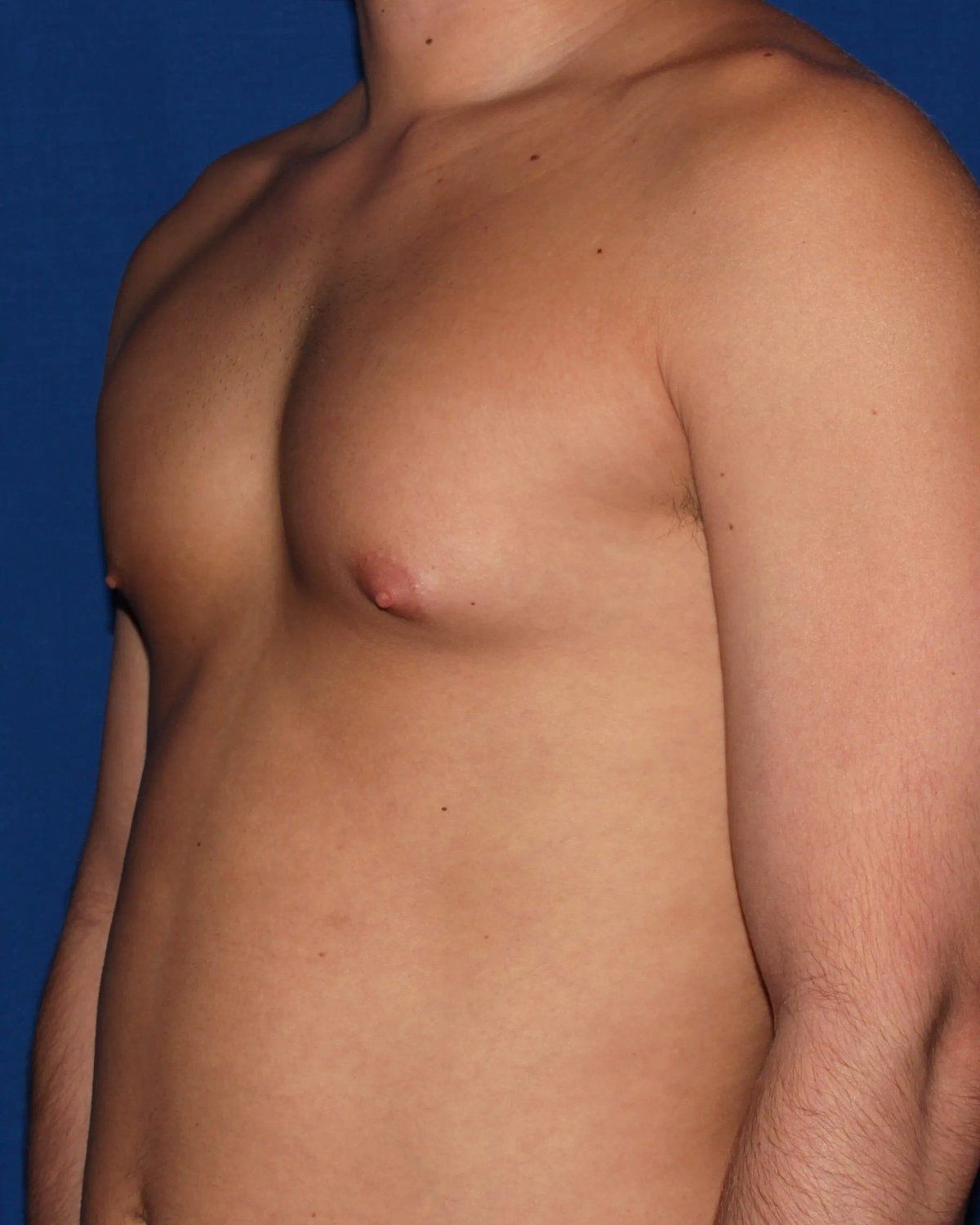 One-Stitch Gynecomastia — Oblique Right view, before