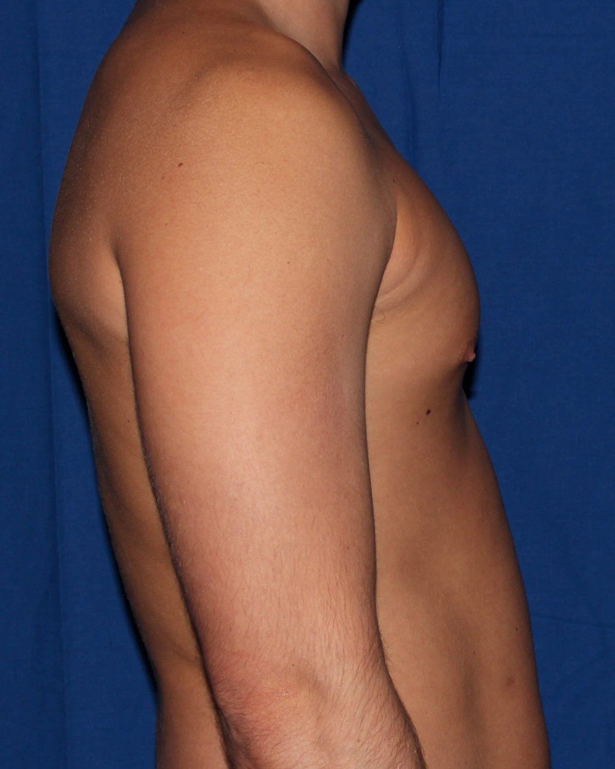 One-Stitch Gynecomastia before