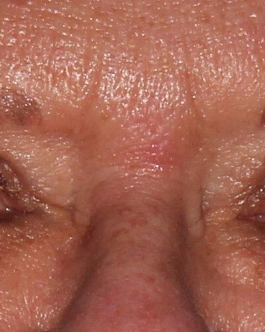 After Eyelid Surgery
