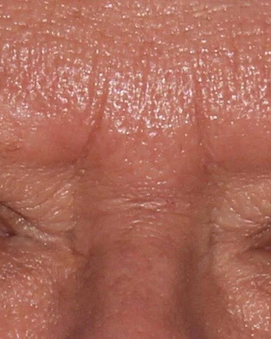Before Eyelid Surgery