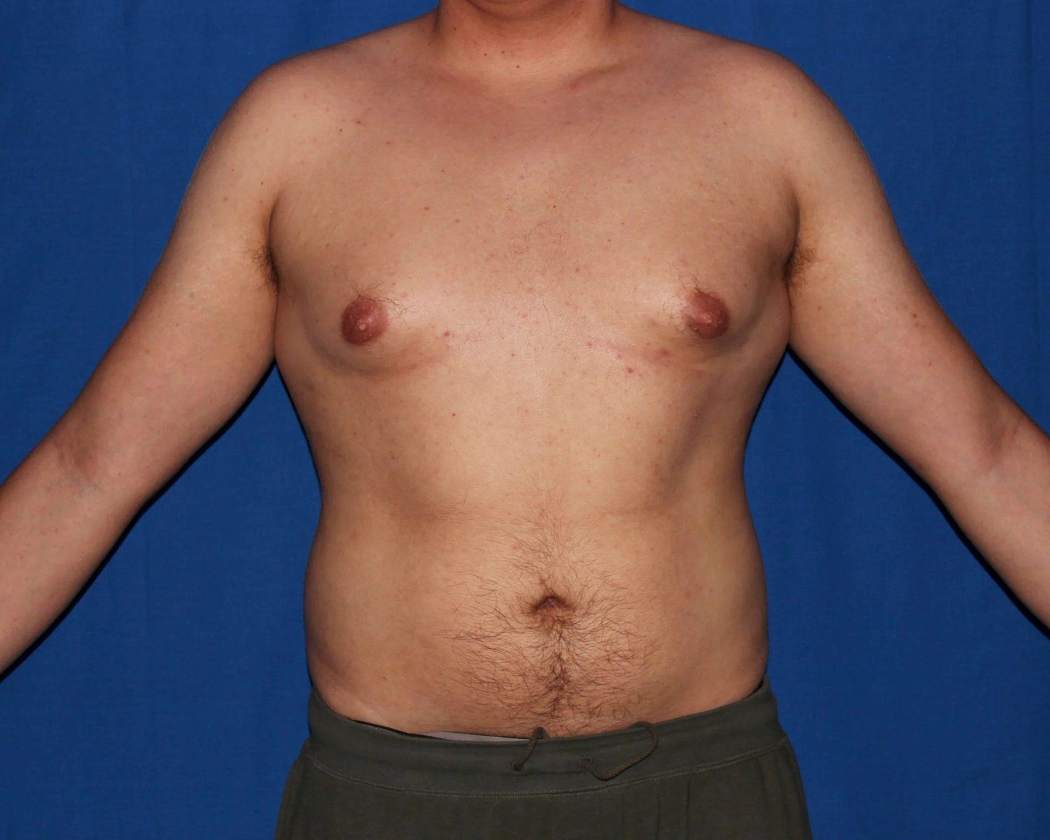 One-Stitch Gynecomastia before
