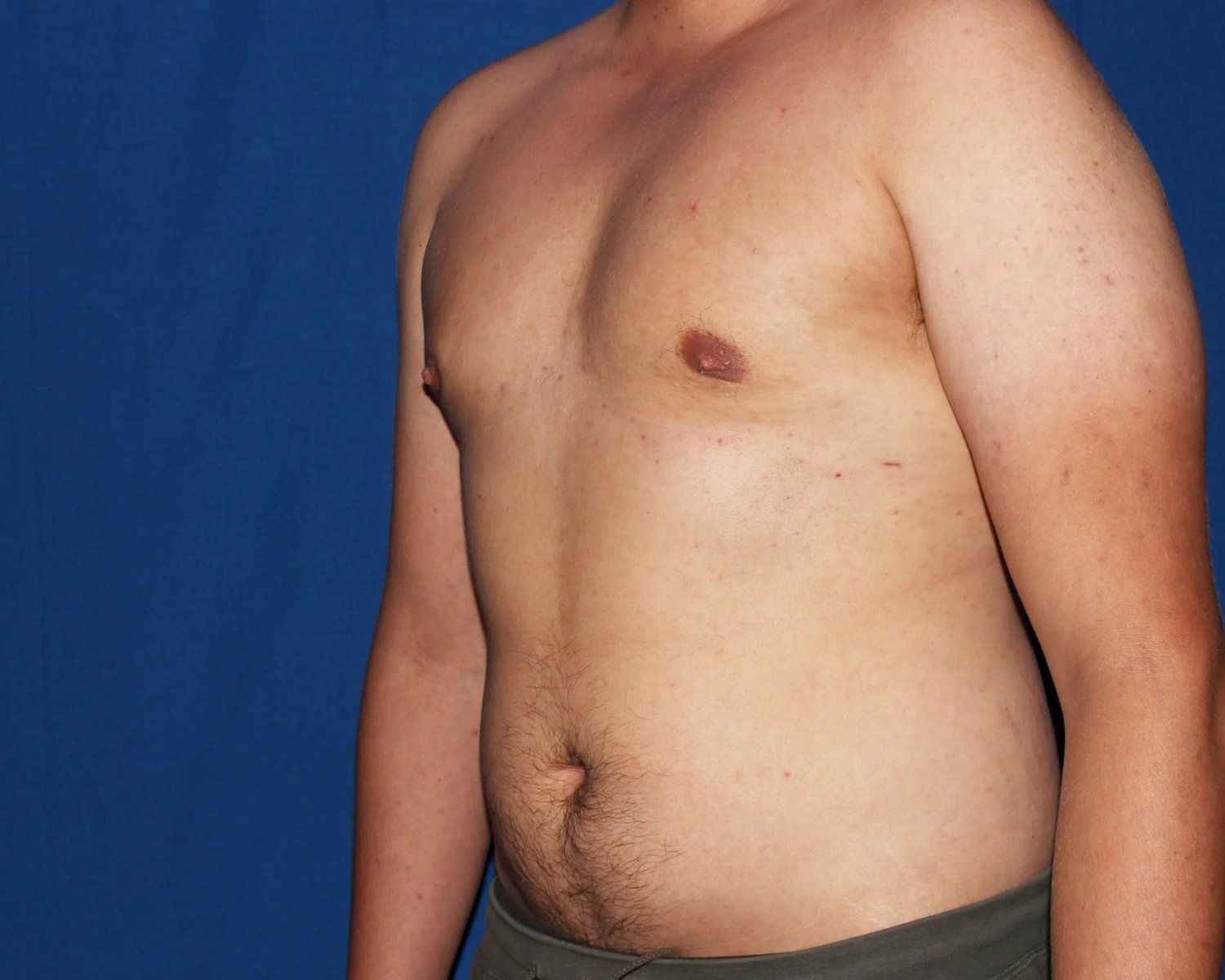 One-Stitch Gynecomastia — Oblique Right view, after