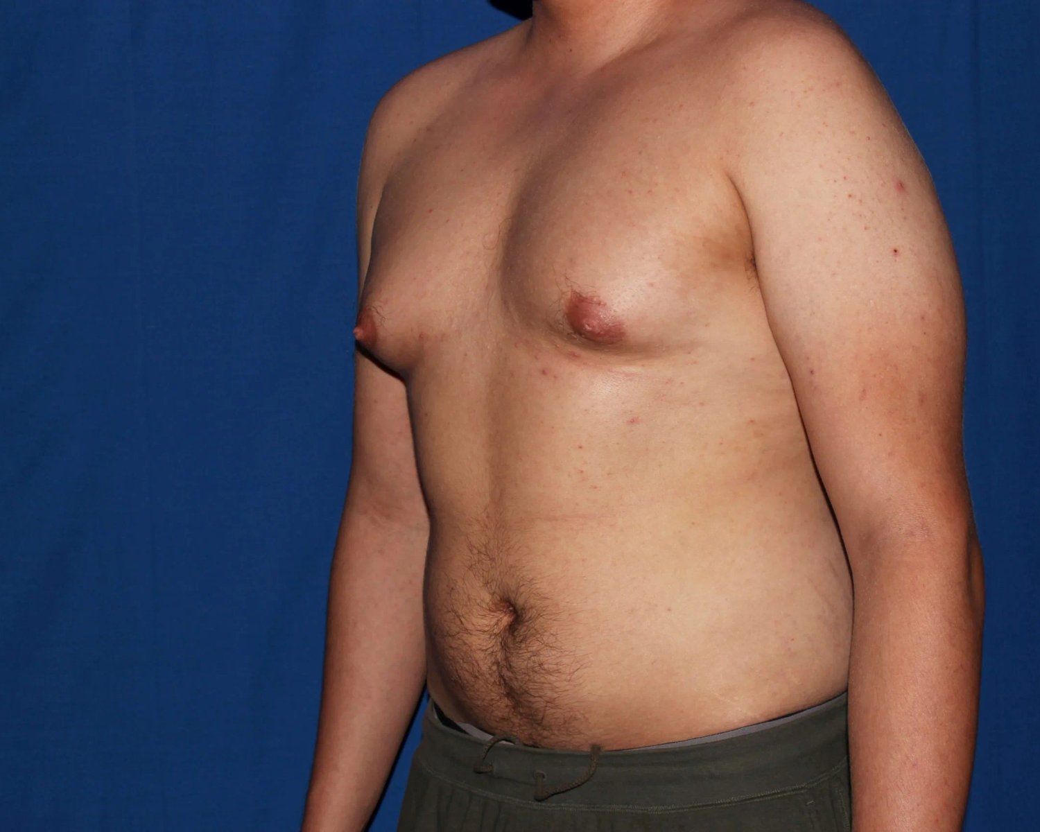 One-Stitch Gynecomastia — Oblique Right view, before