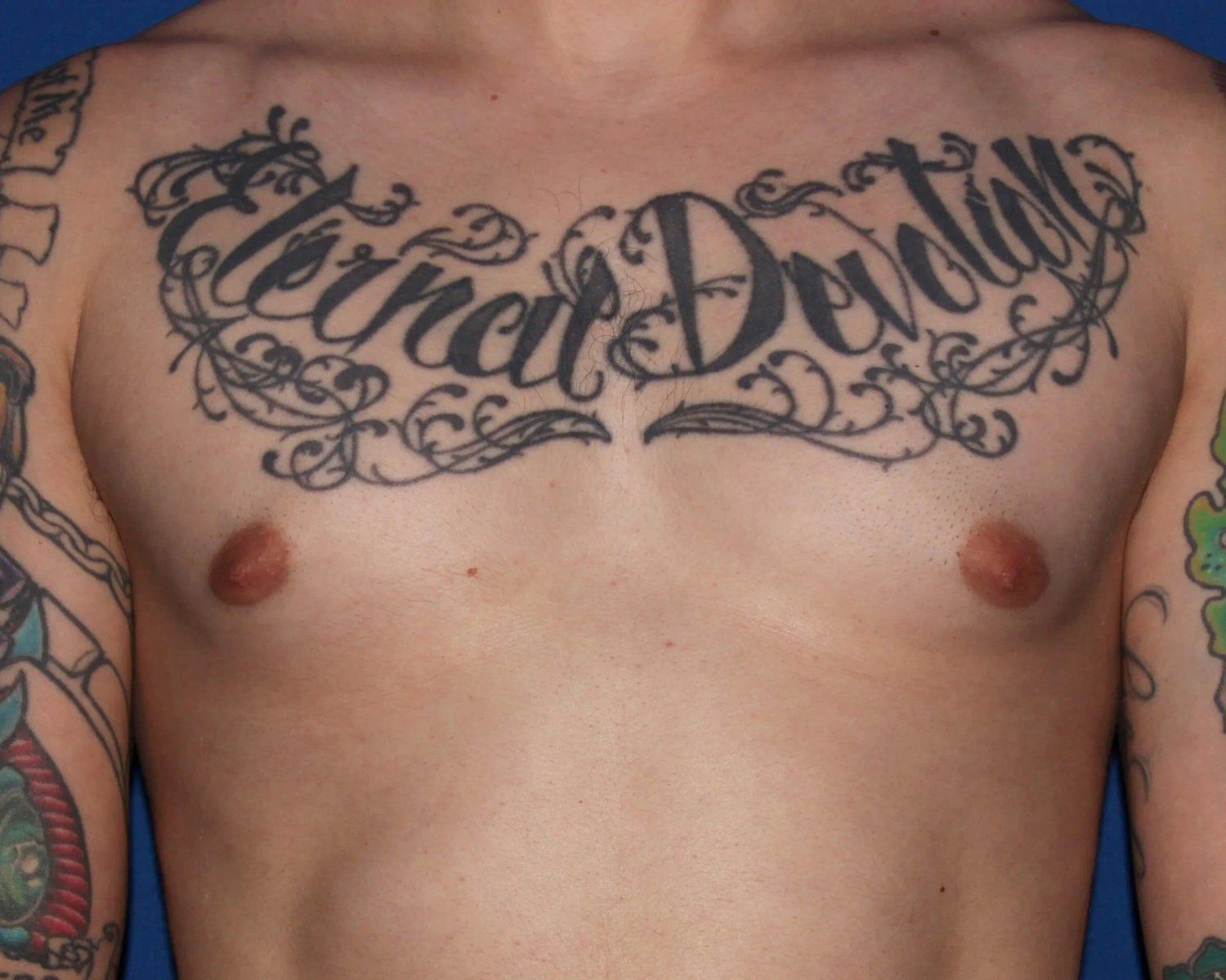 One-Stitch Gynecomastia before