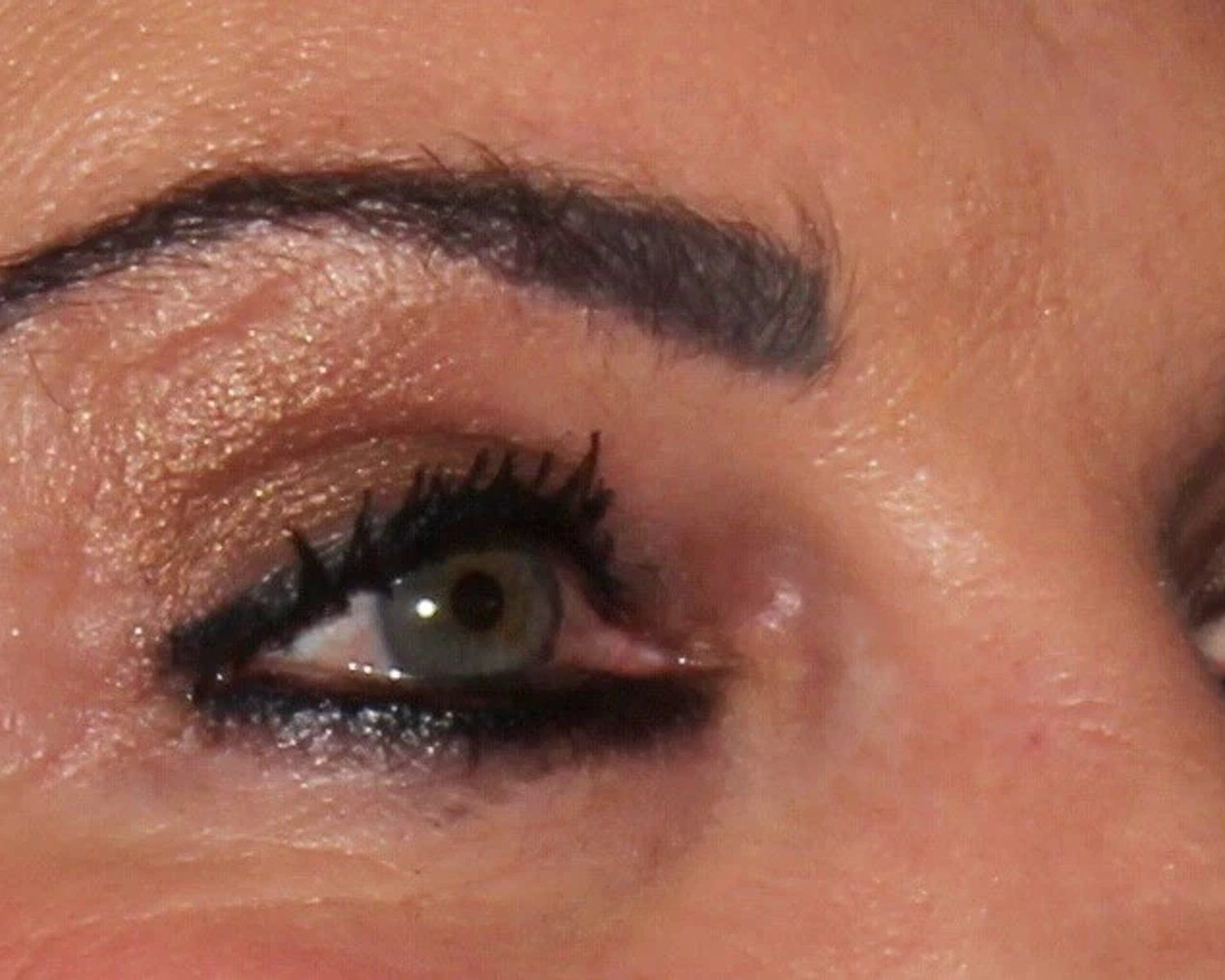 Eyelid Surgery after