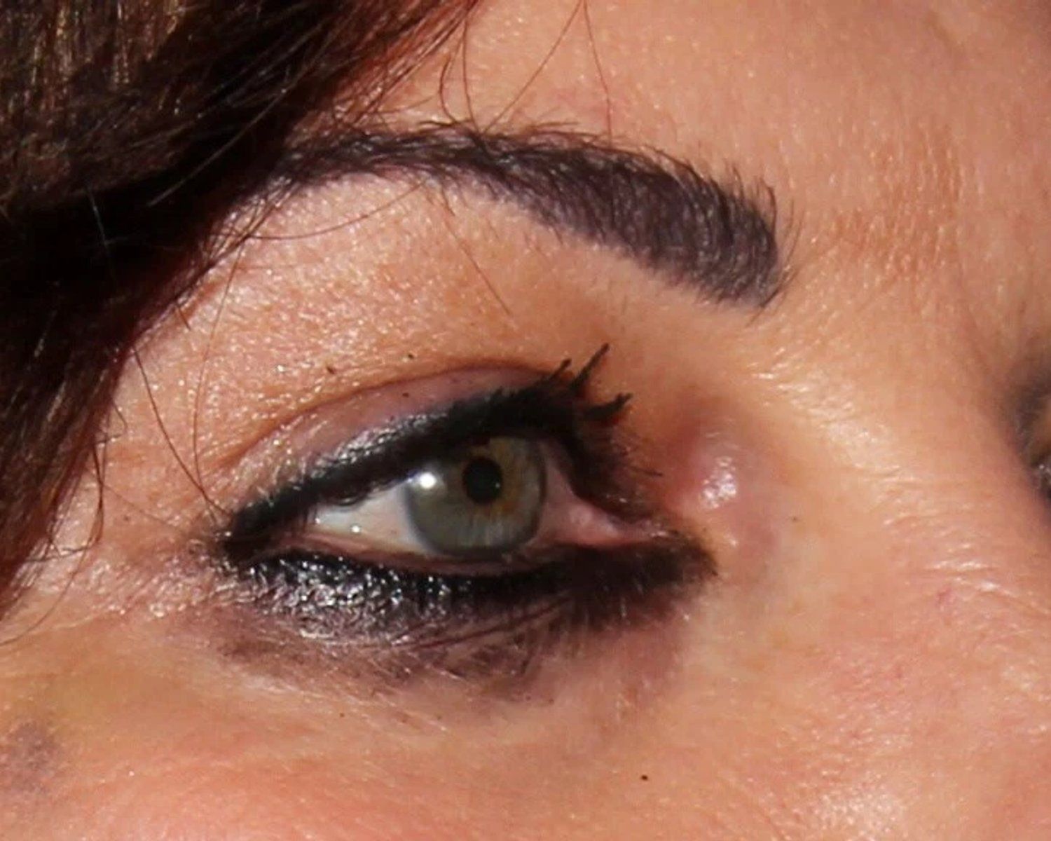 Eyelid Surgery before