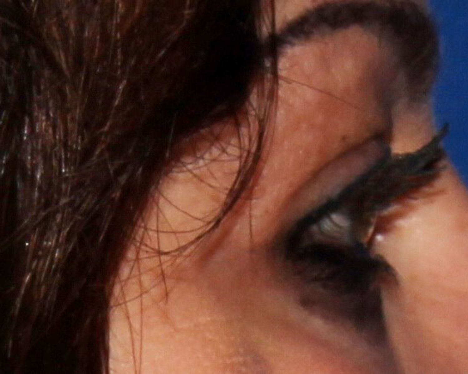 Eyelid Surgery, Oblique Right view, before