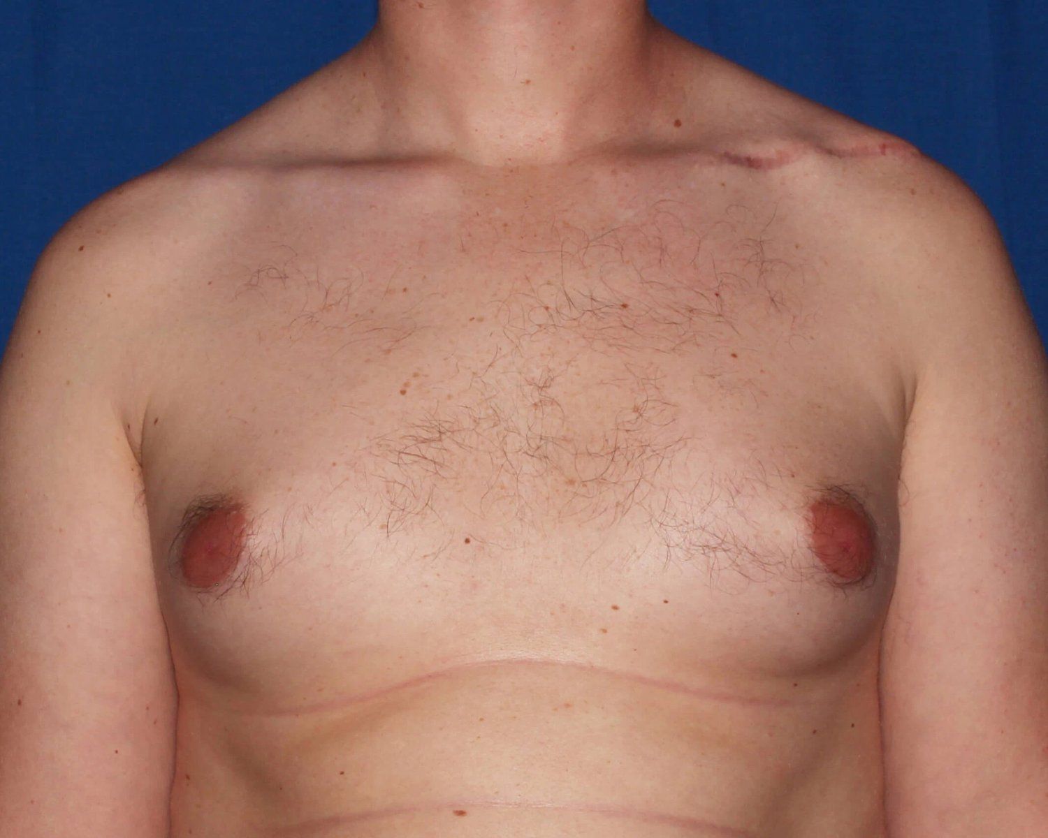 One-Stitch Gynecomastia before