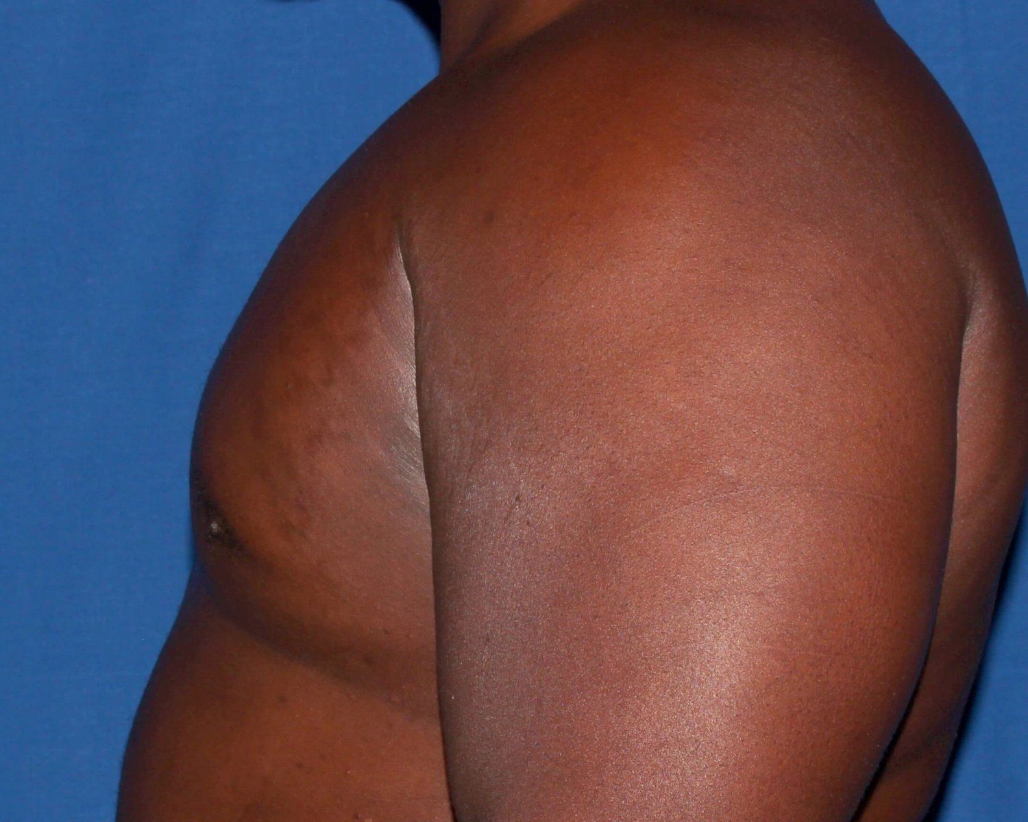 One-Stitch Gynecomastia — Oblique Left view, after