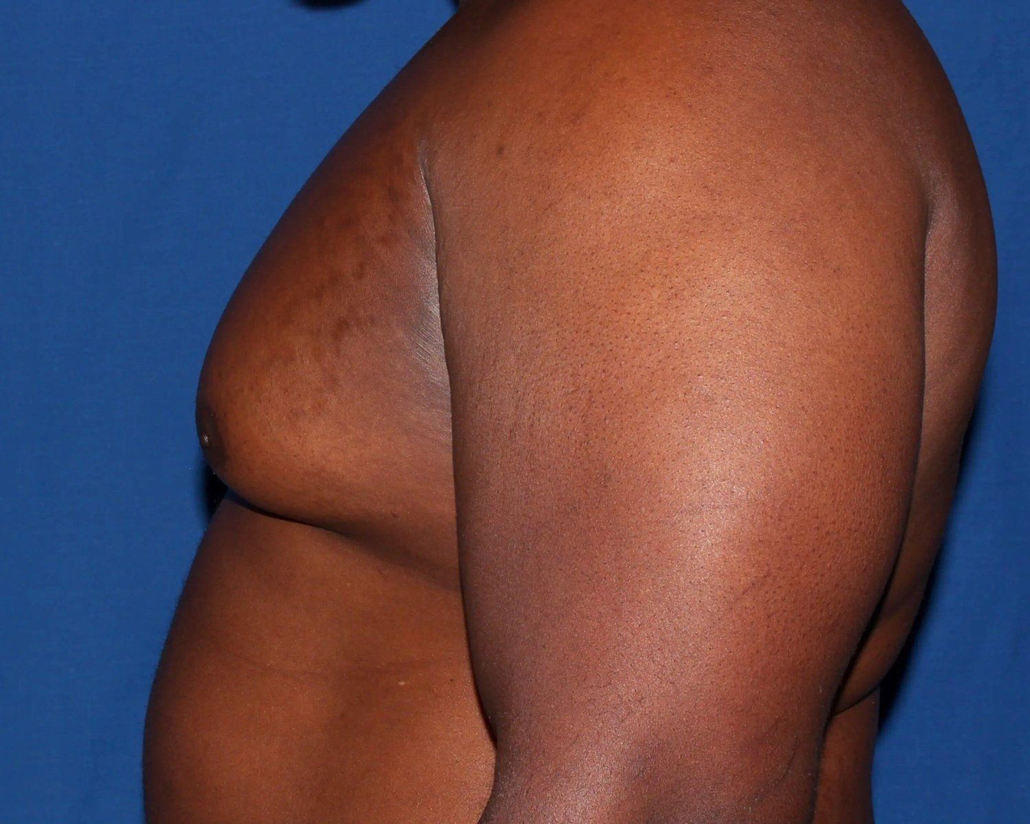 One-Stitch Gynecomastia — Oblique Left view, before