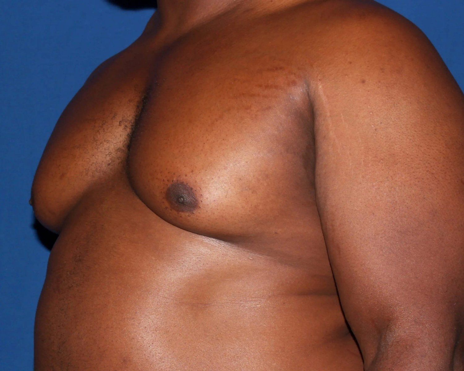 One-Stitch Gynecomastia before