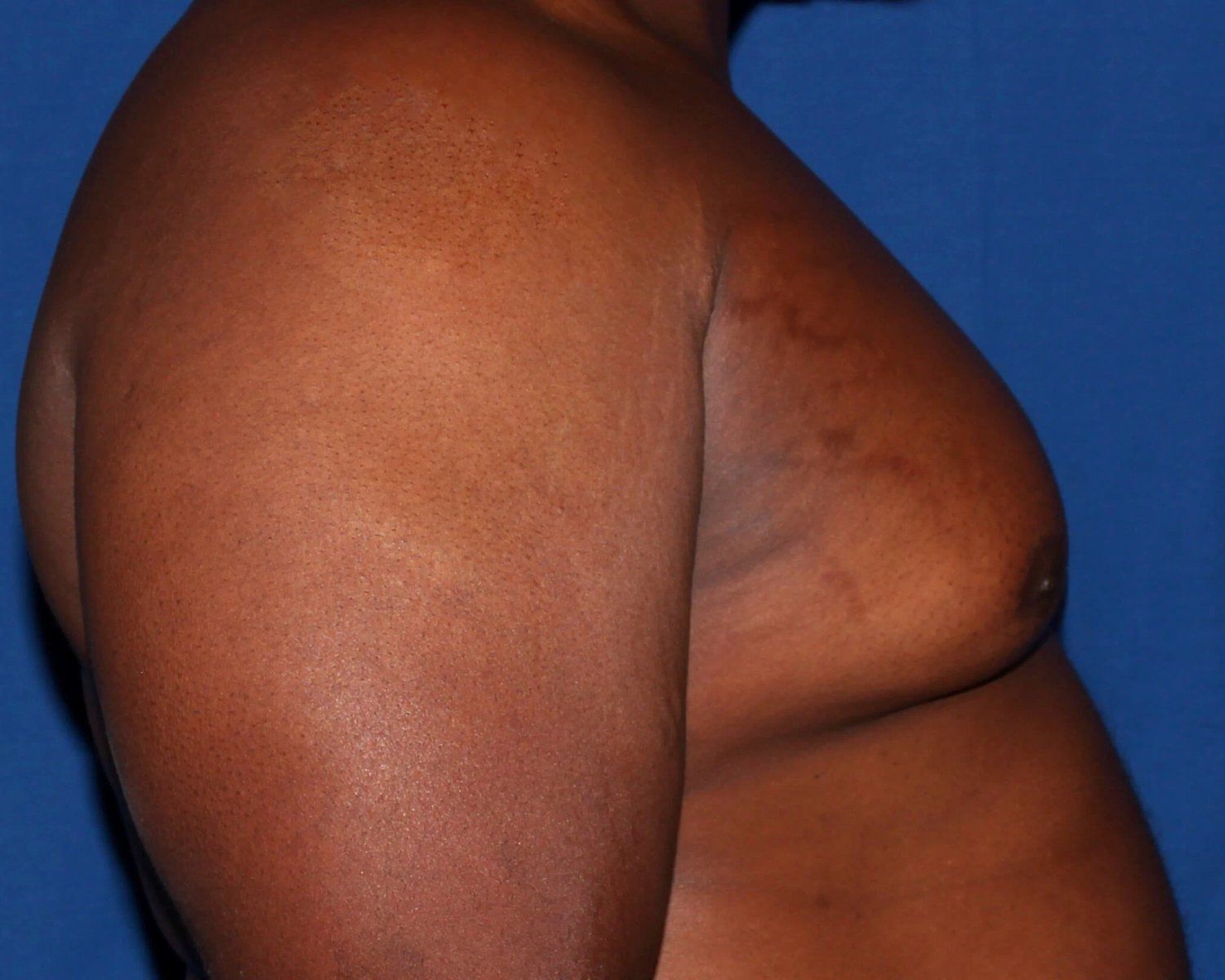 One-Stitch Gynecomastia — Oblique Right view, before
