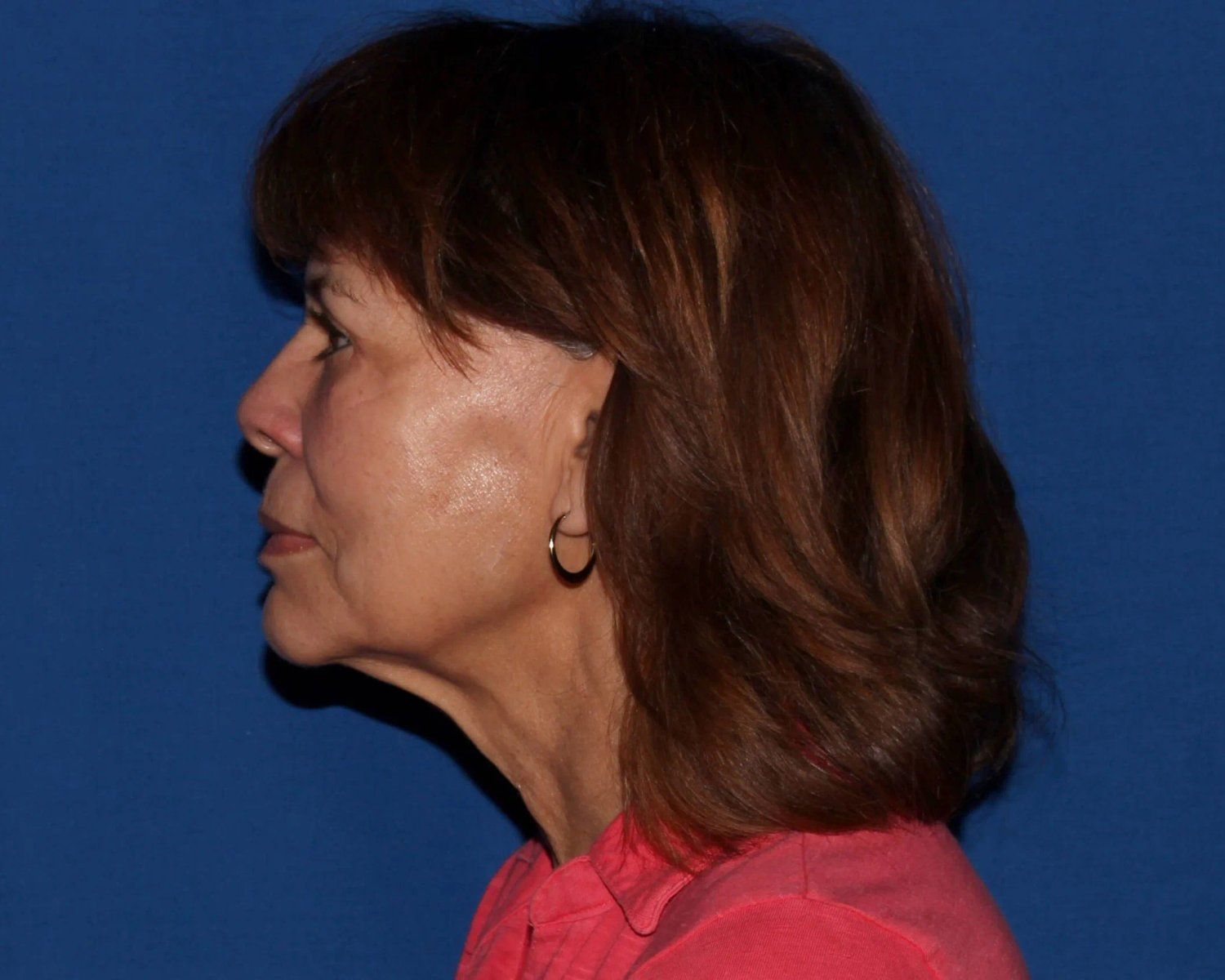 Facelift (neck lift included) — Oblique Left view, before