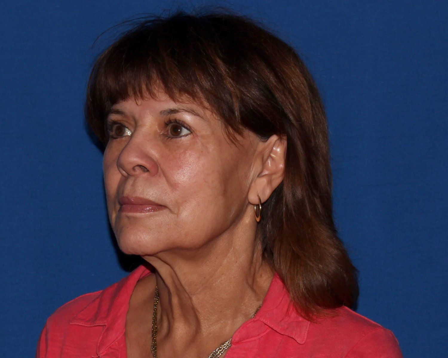 Facelift (neck lift included) — Oblique Right view, before