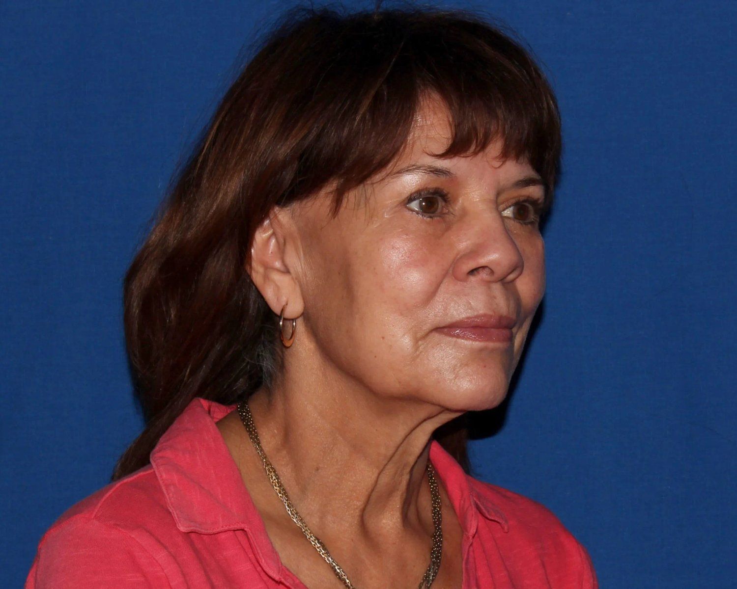Facelift (neck lift included) before
