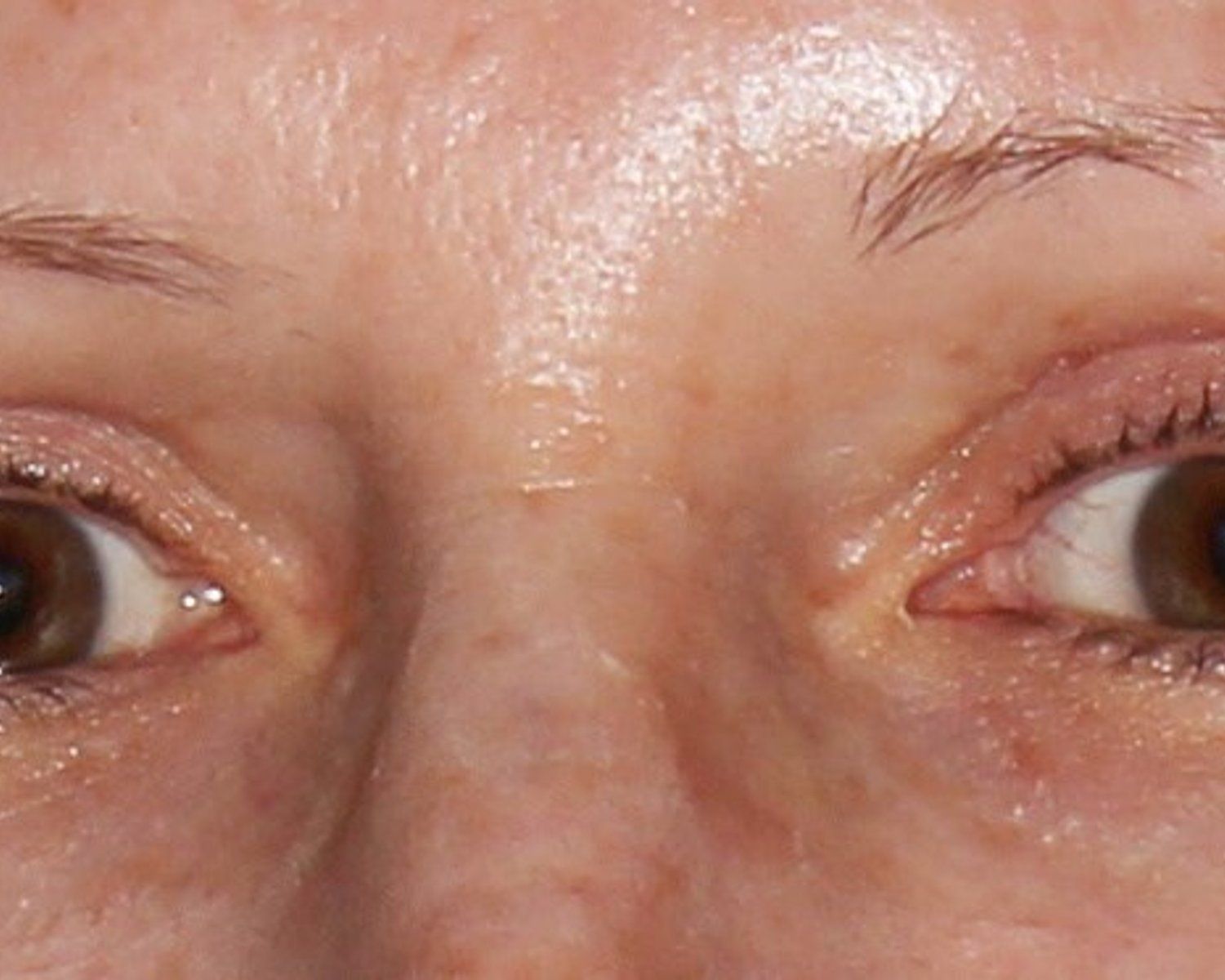 Eyelid Surgery after