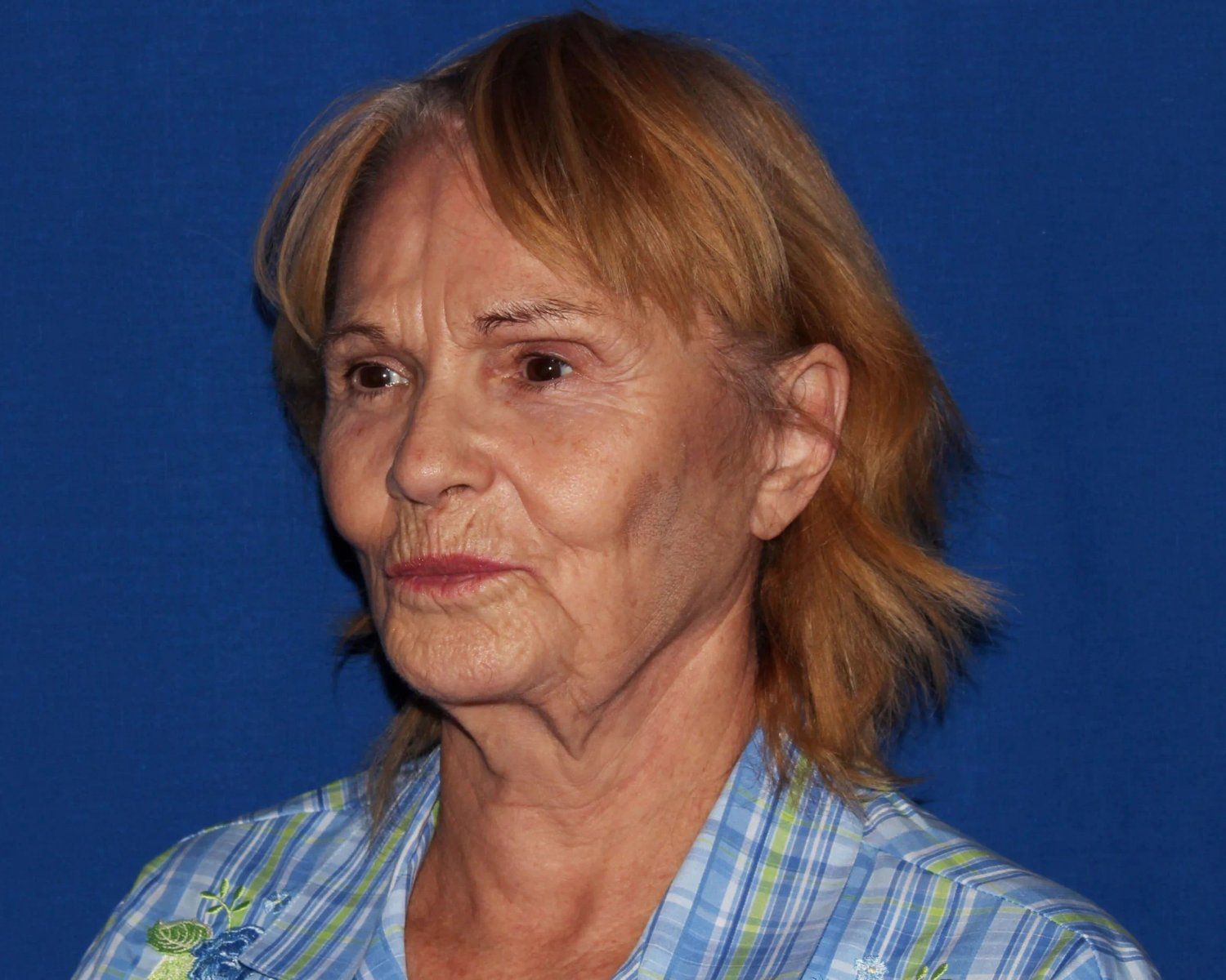 Facelift (neck lift included) — Oblique Right view, before