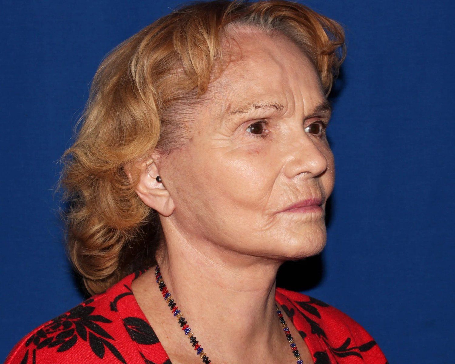 Facelift (neck lift included) after