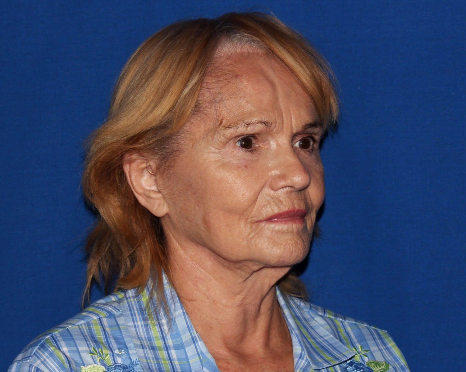 Facelift (neck lift included) before