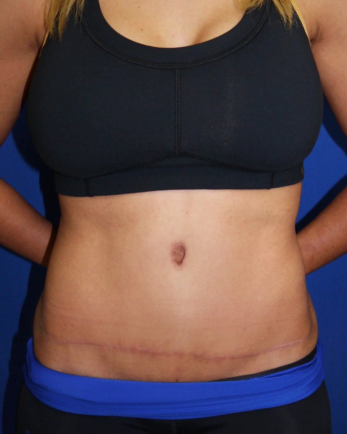 Tummy Tuck after