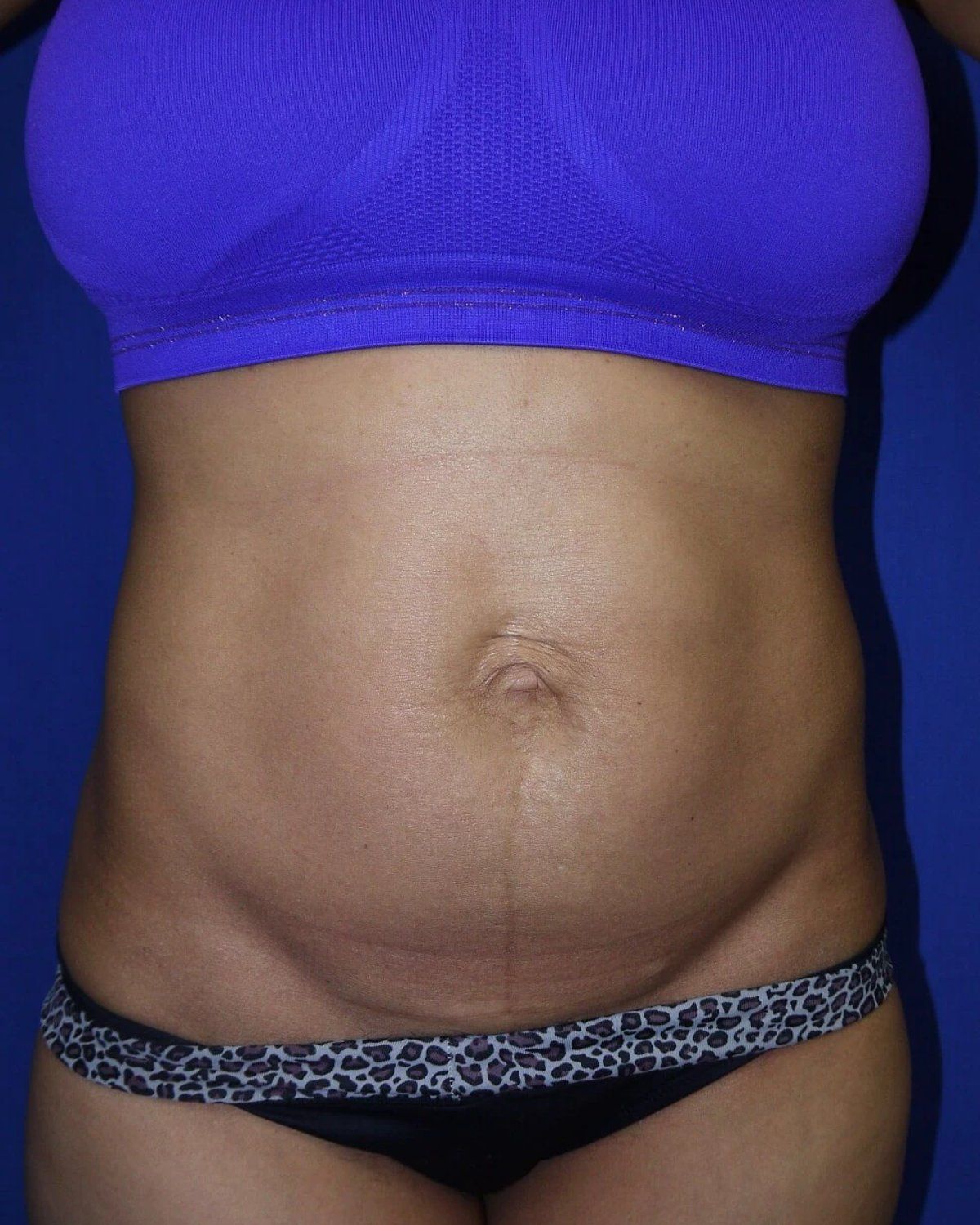 Tummy Tuck before