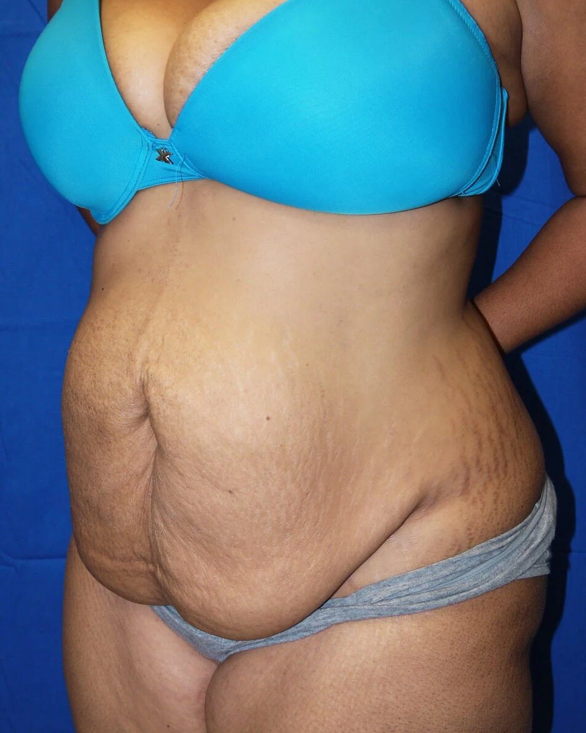 Tummy Tuck before