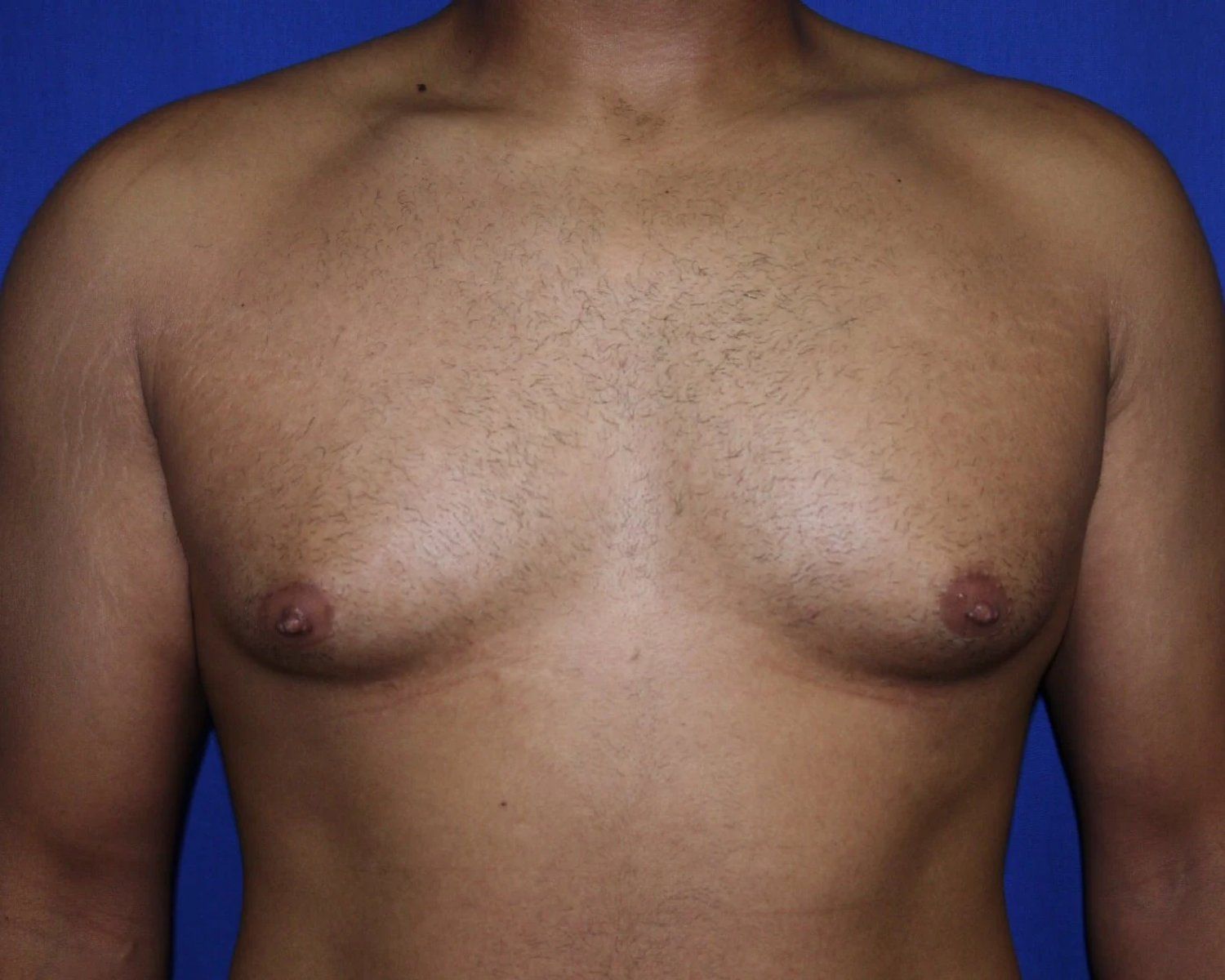 One-Stitch Gynecomastia before