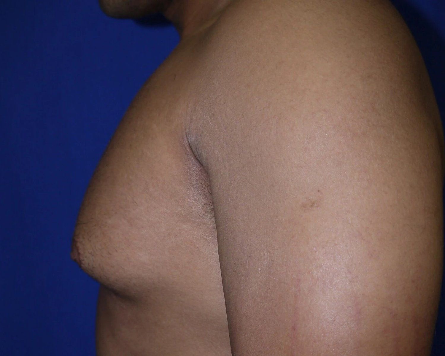 One-Stitch Gynecomastia — Oblique Left view, before