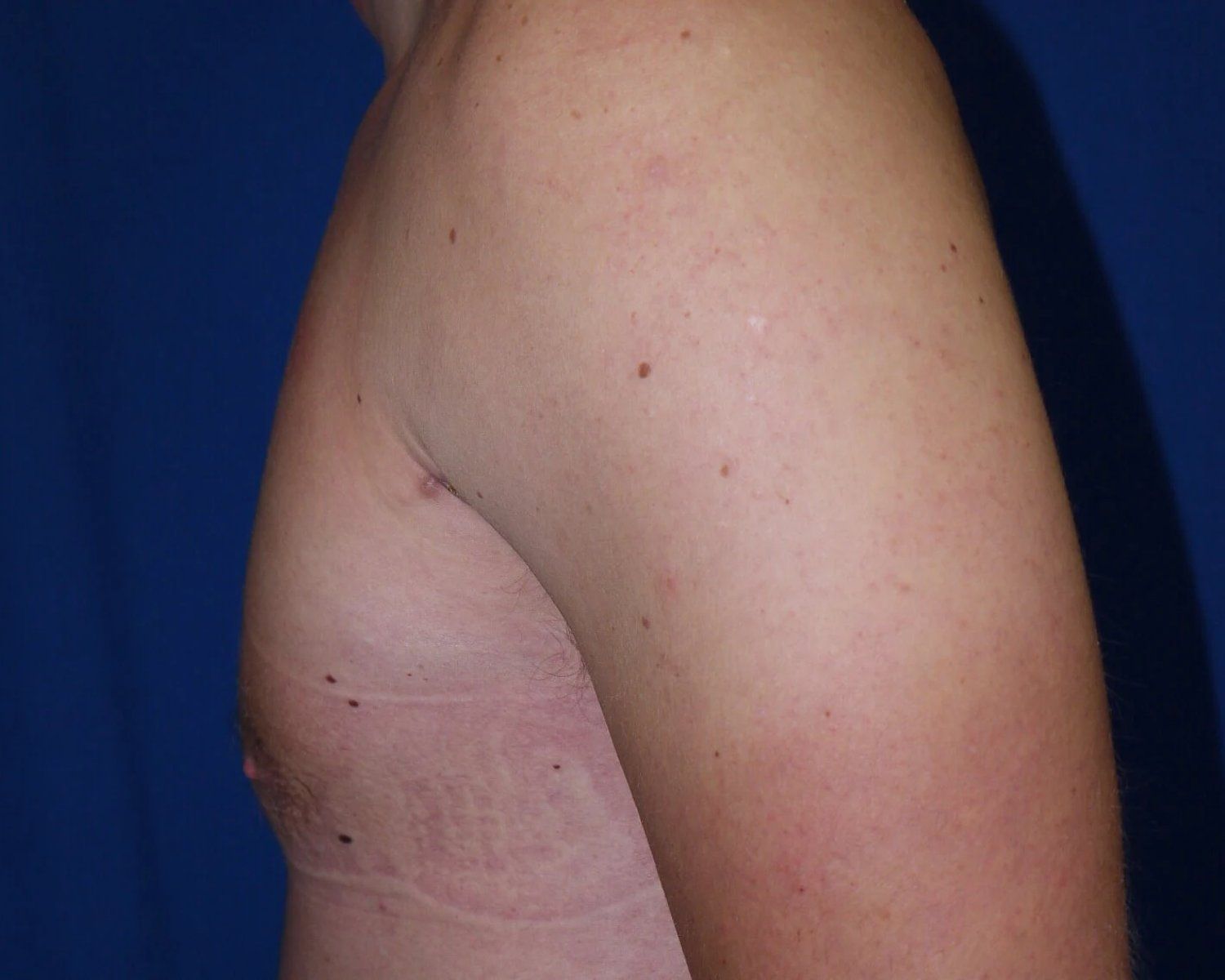 One-Stitch Gynecomastia — Oblique Left view, after