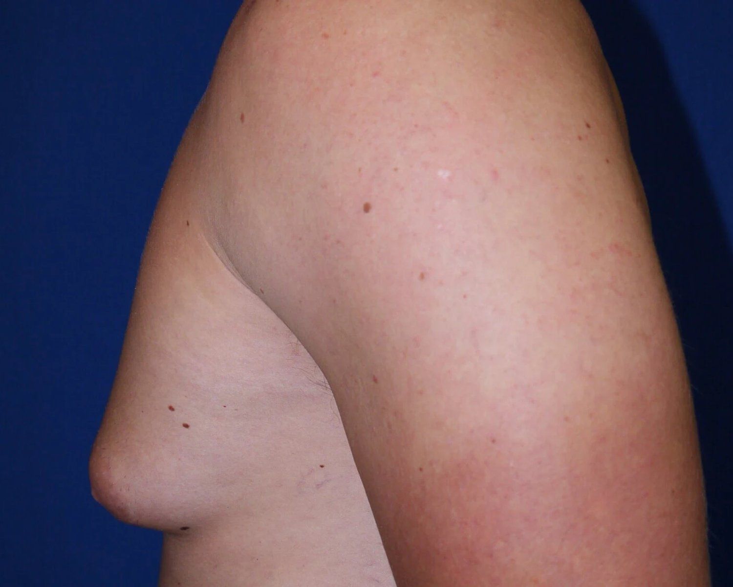 One-Stitch Gynecomastia — Oblique Left view, before