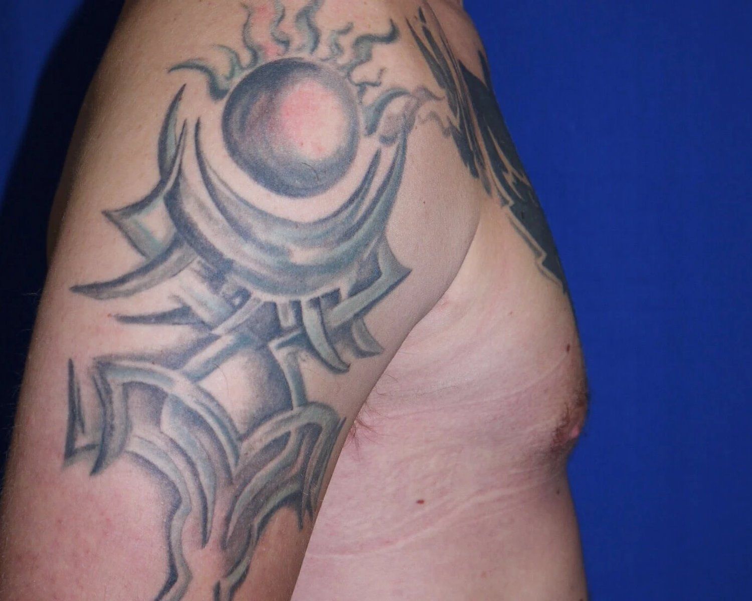 One-Stitch Gynecomastia — Oblique Right view, after