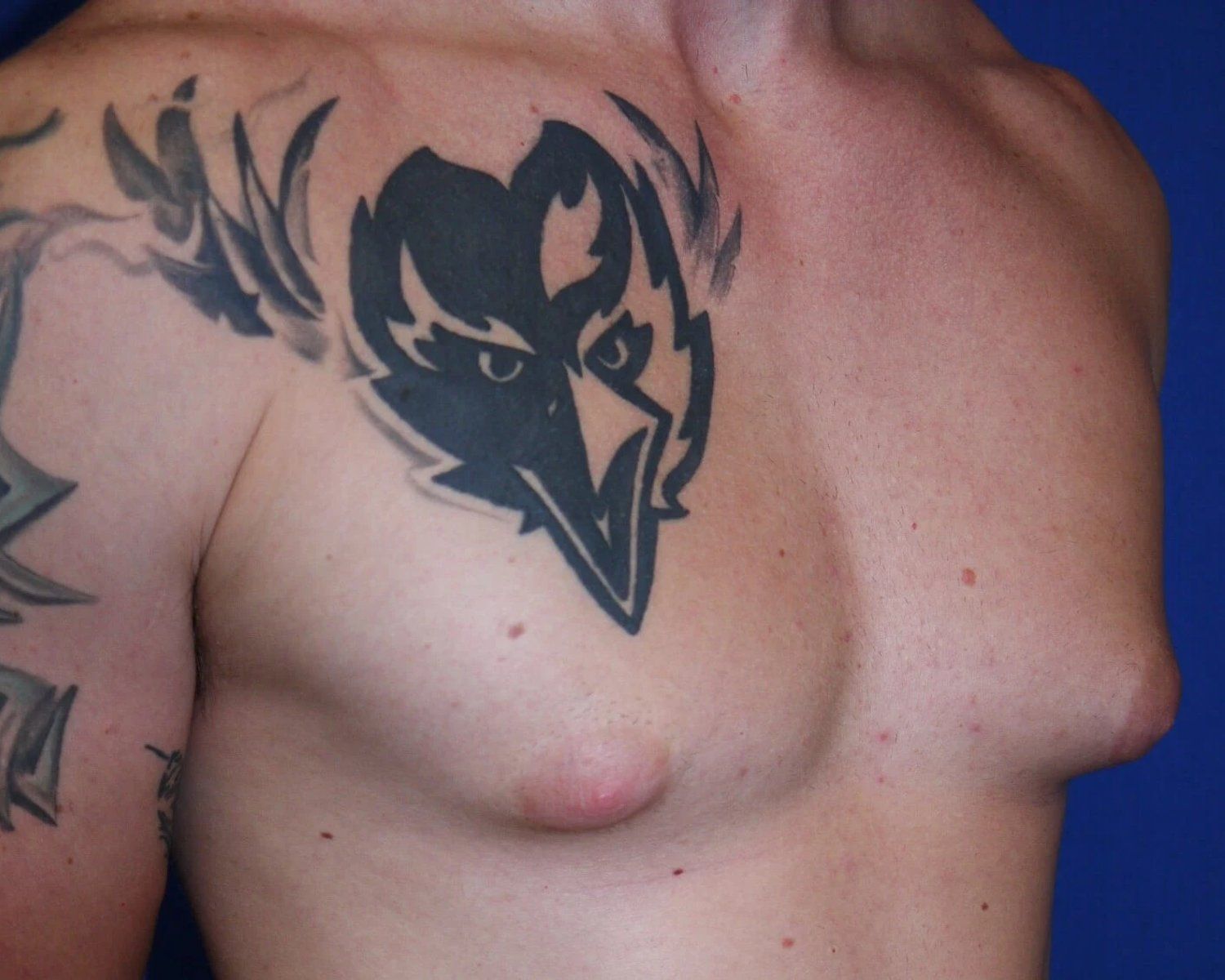 One-Stitch Gynecomastia before