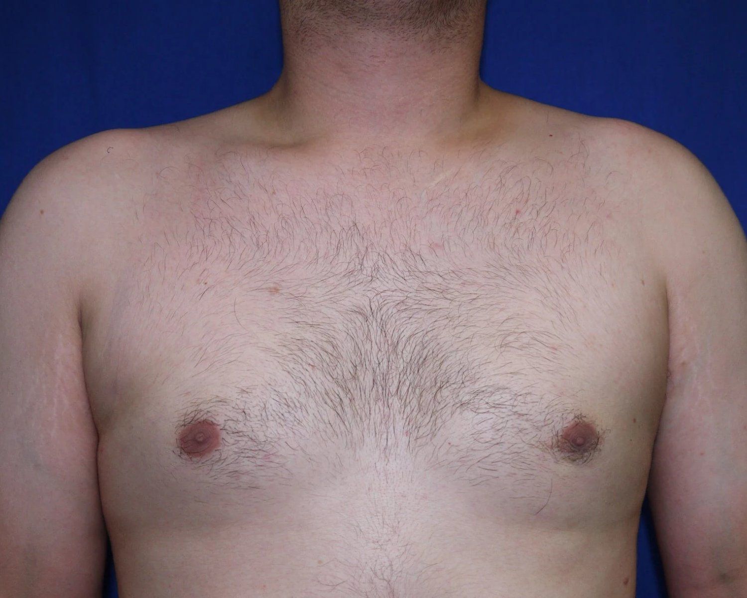 One-Stitch Gynecomastia after