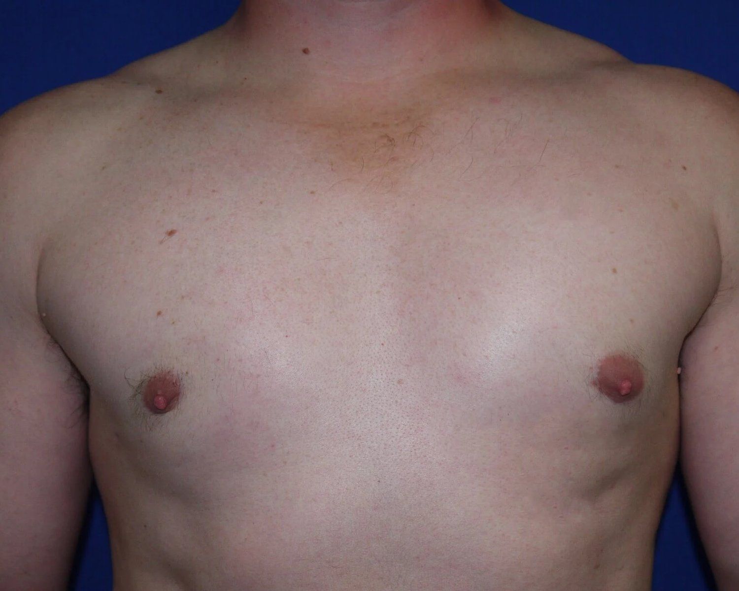 One-Stitch Gynecomastia after
