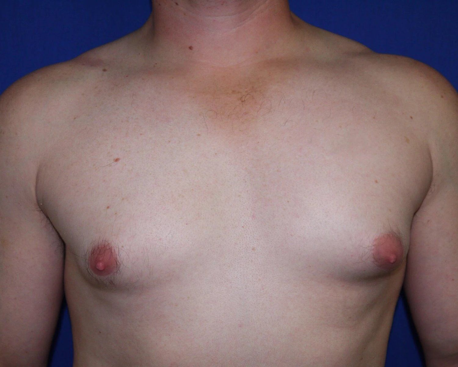 One-Stitch Gynecomastia before