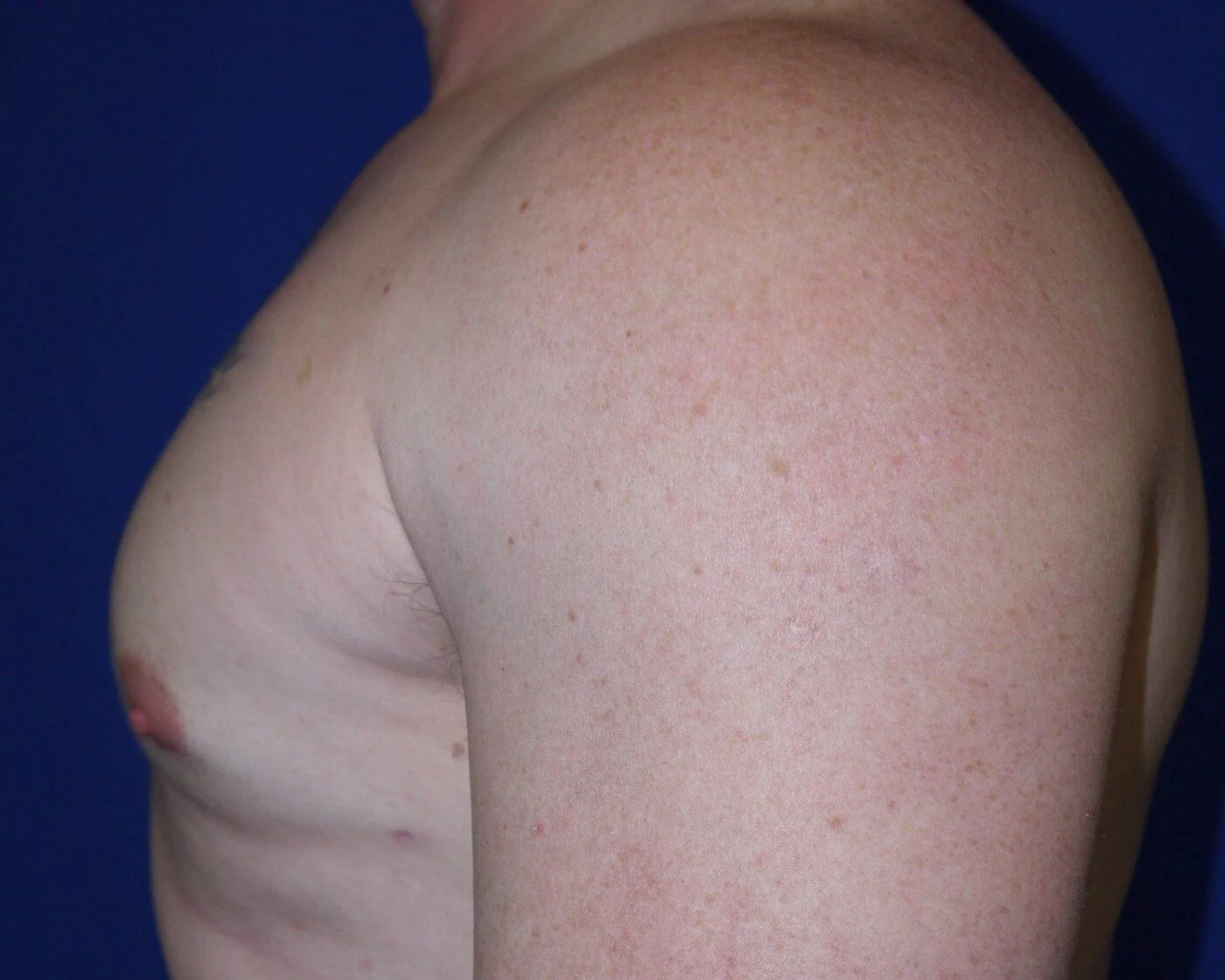 One-Stitch Gynecomastia — Oblique Left view, after
