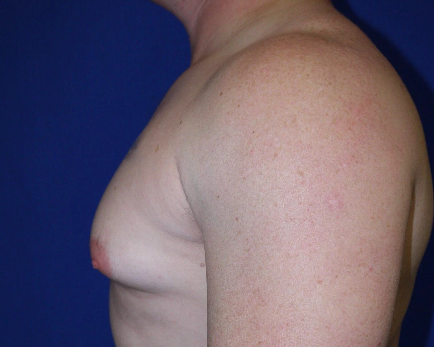 One-Stitch Gynecomastia — Oblique Left view, before