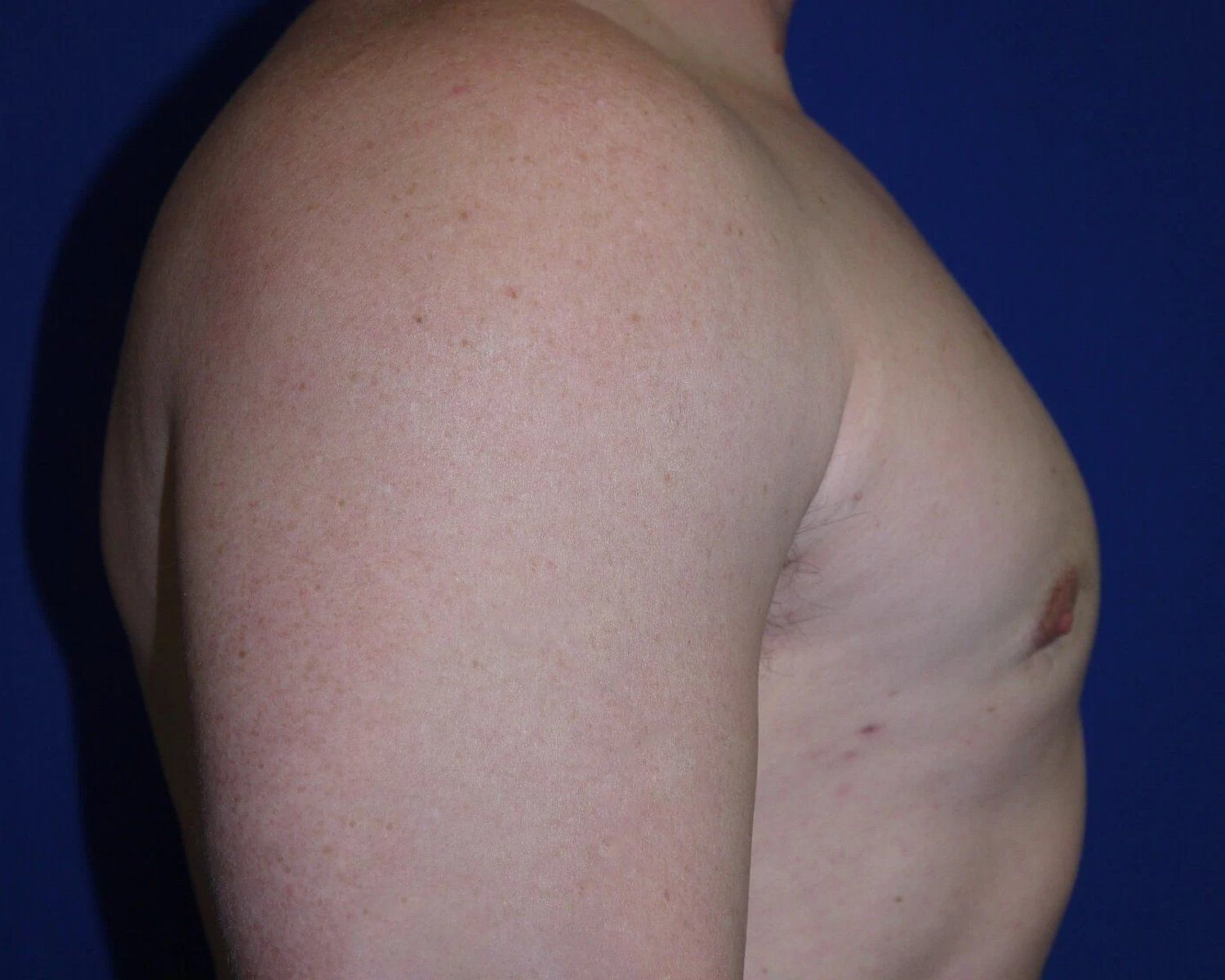 One-Stitch Gynecomastia — Oblique Right view, after